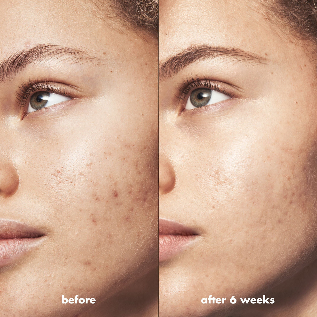 Blemish Breakthrough Triple-acid Resurfacing Serum